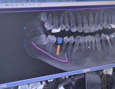 インプラント義歯02